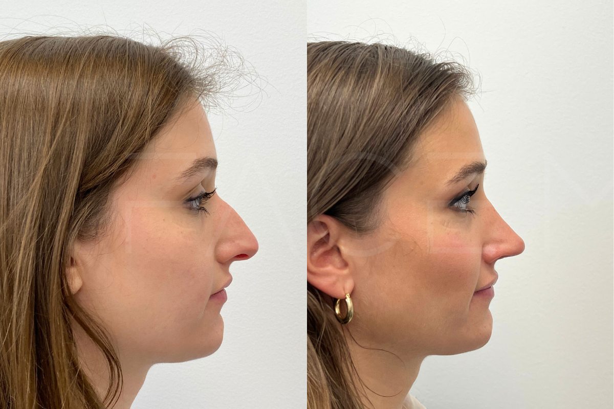 Rhinoplasty in Dubai: A Complete Guide to Nose Reshaping