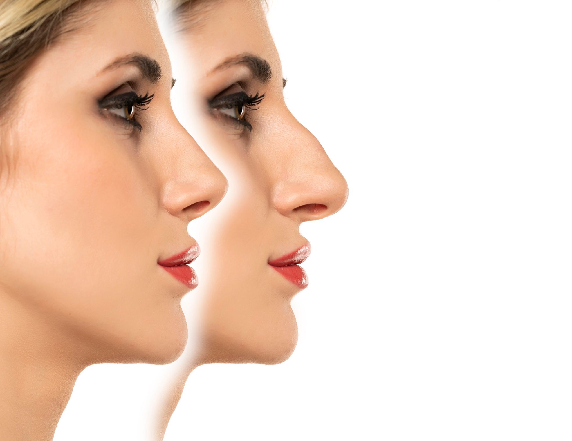 Ultrasonic rhinoplasty dubai: How It Ensures Faster Recovery and Natural Results
